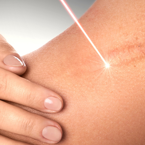 LASER TREATMENT